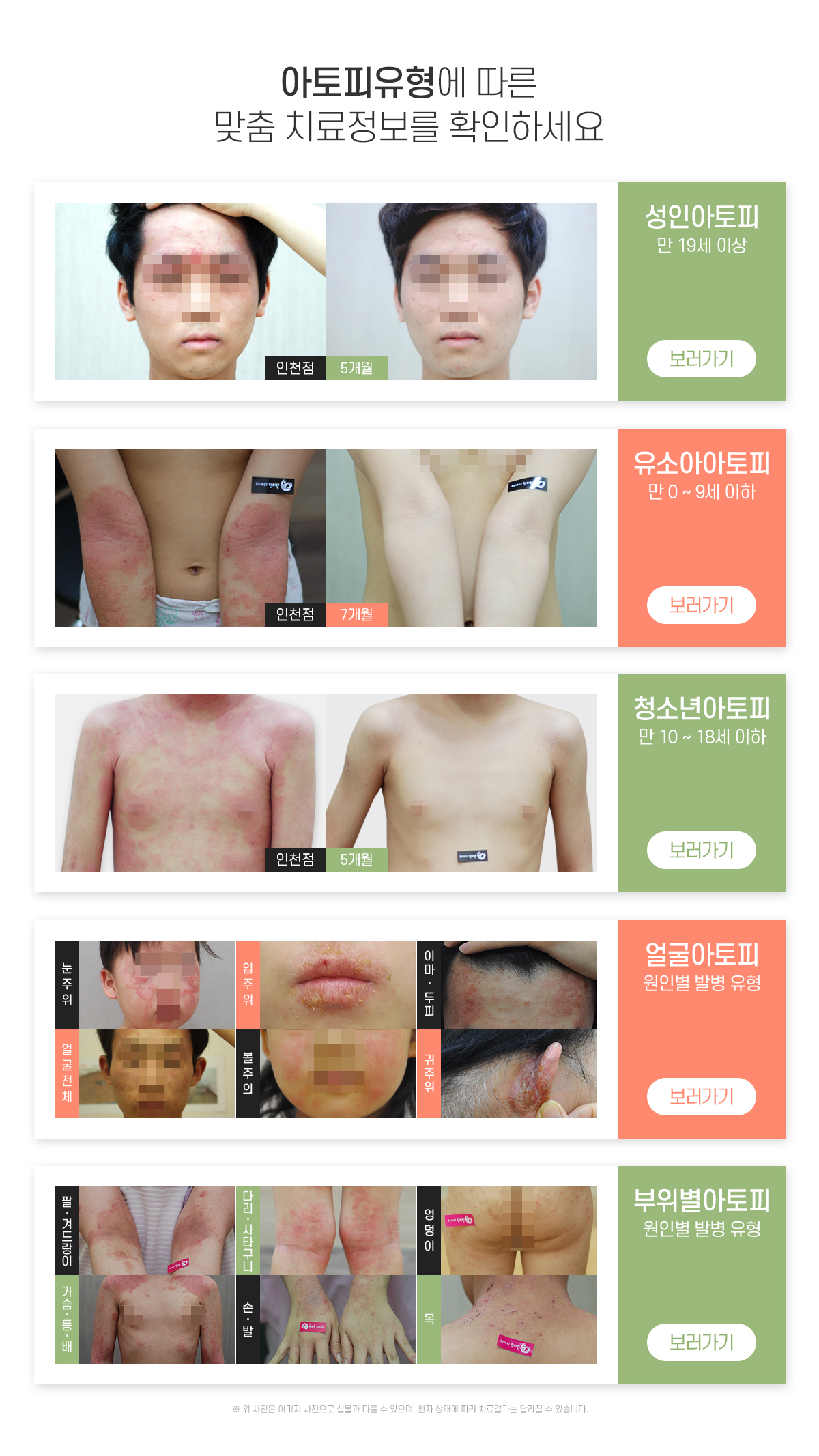 아토피 유형에 따른 맞춤 치료정보