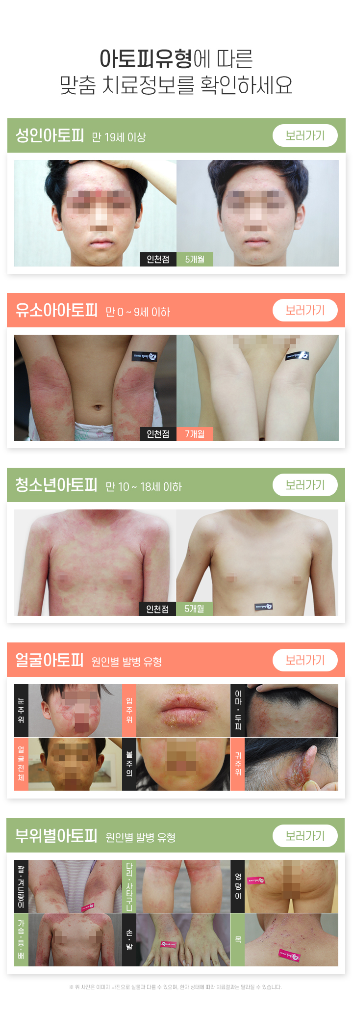 아토피 유형에 따른 맞춤 치료정보