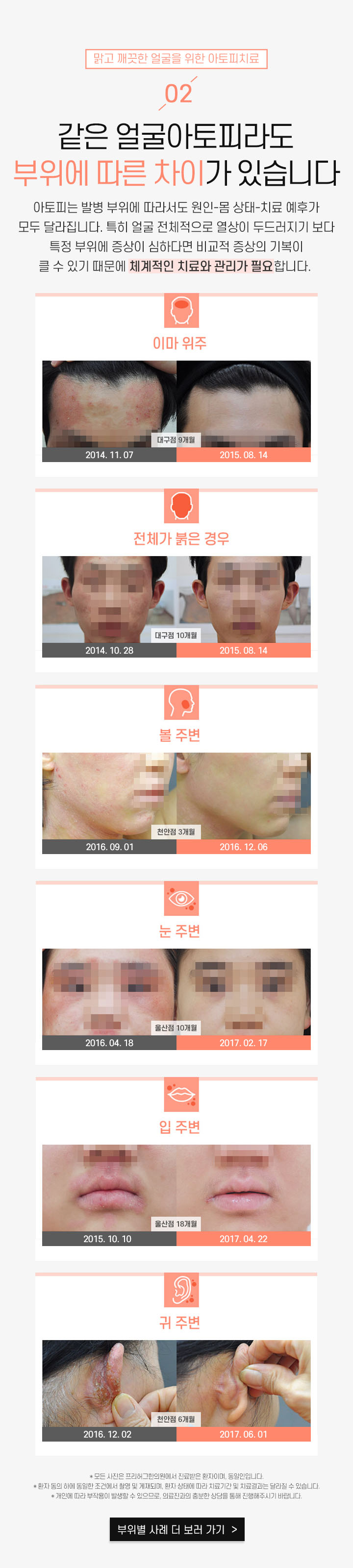 2. 같은 얼굴아토피라도 부위에 따른 차이가 있습니다