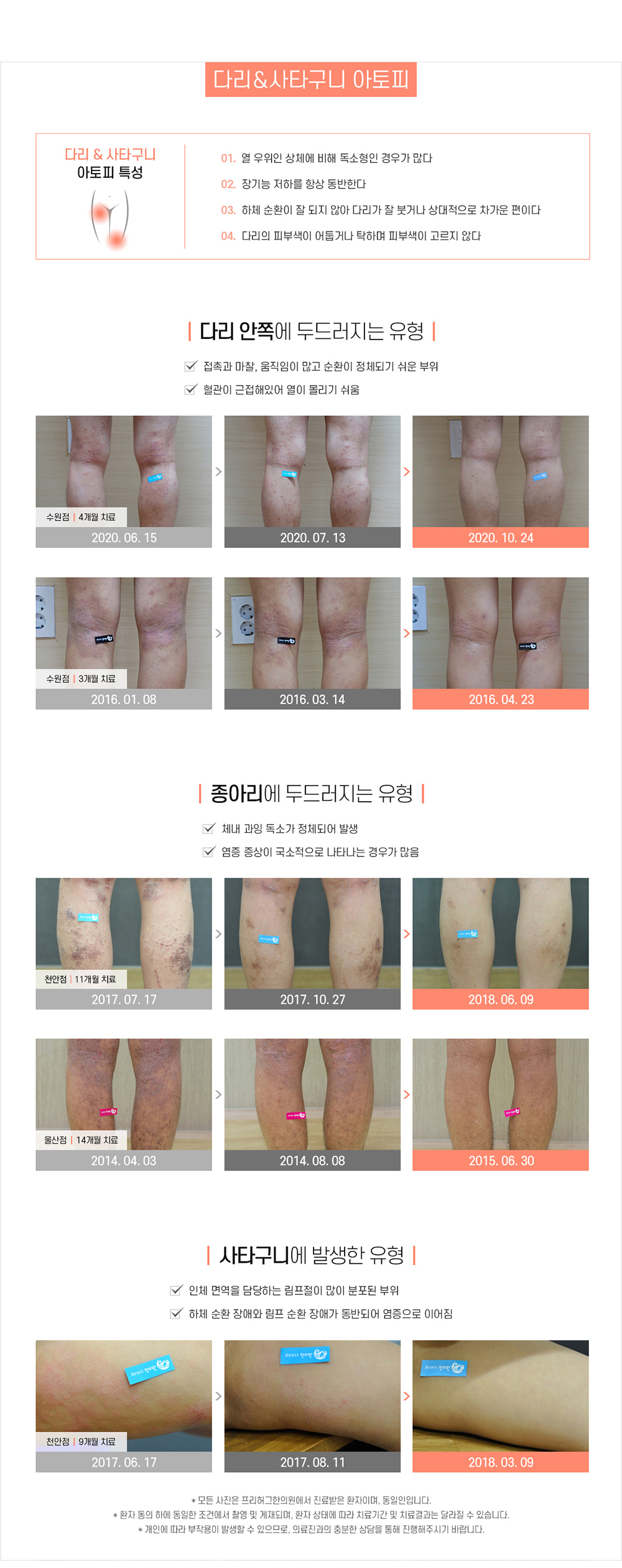 다리/사타구니 아토피