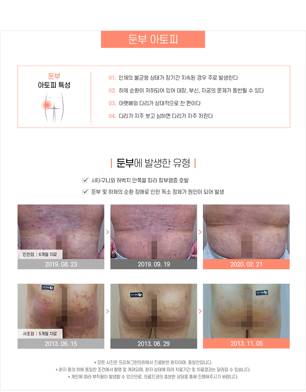 둔부 아토피