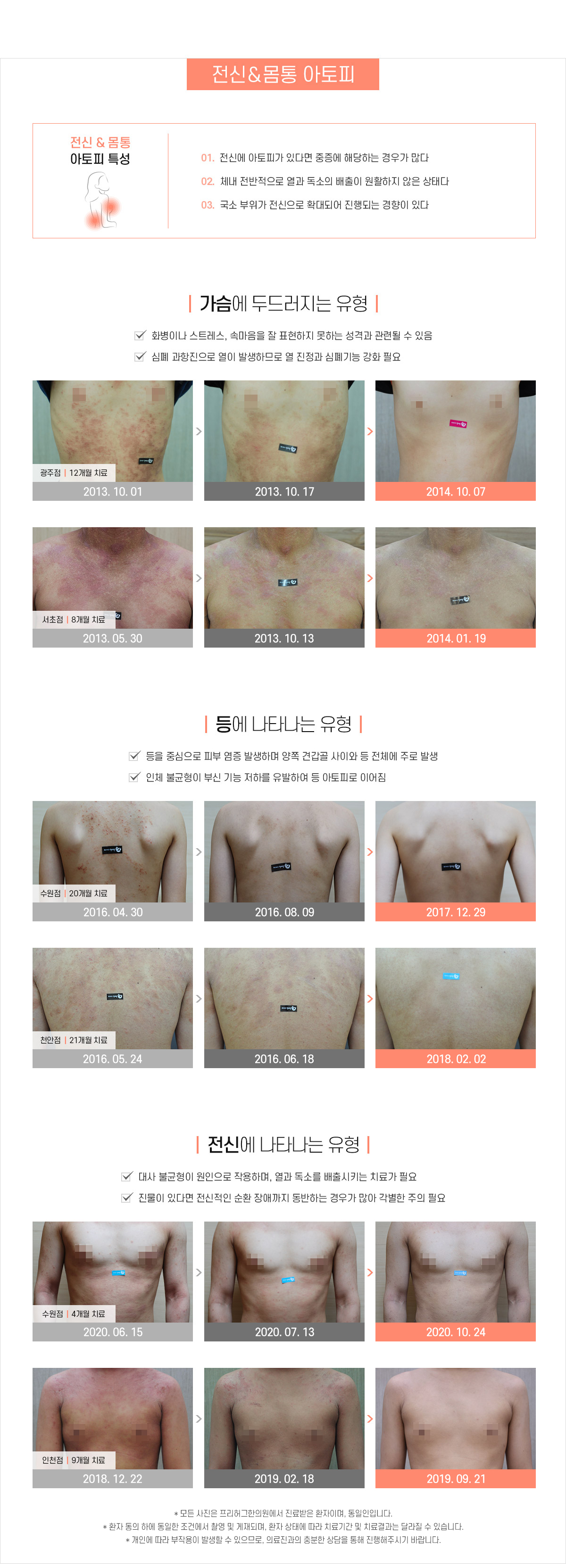 전신/몸통 아토피