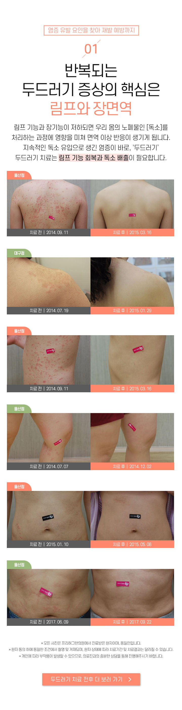 1. 반복되는 두드러기 증상의 핵심은 림프와 장면역