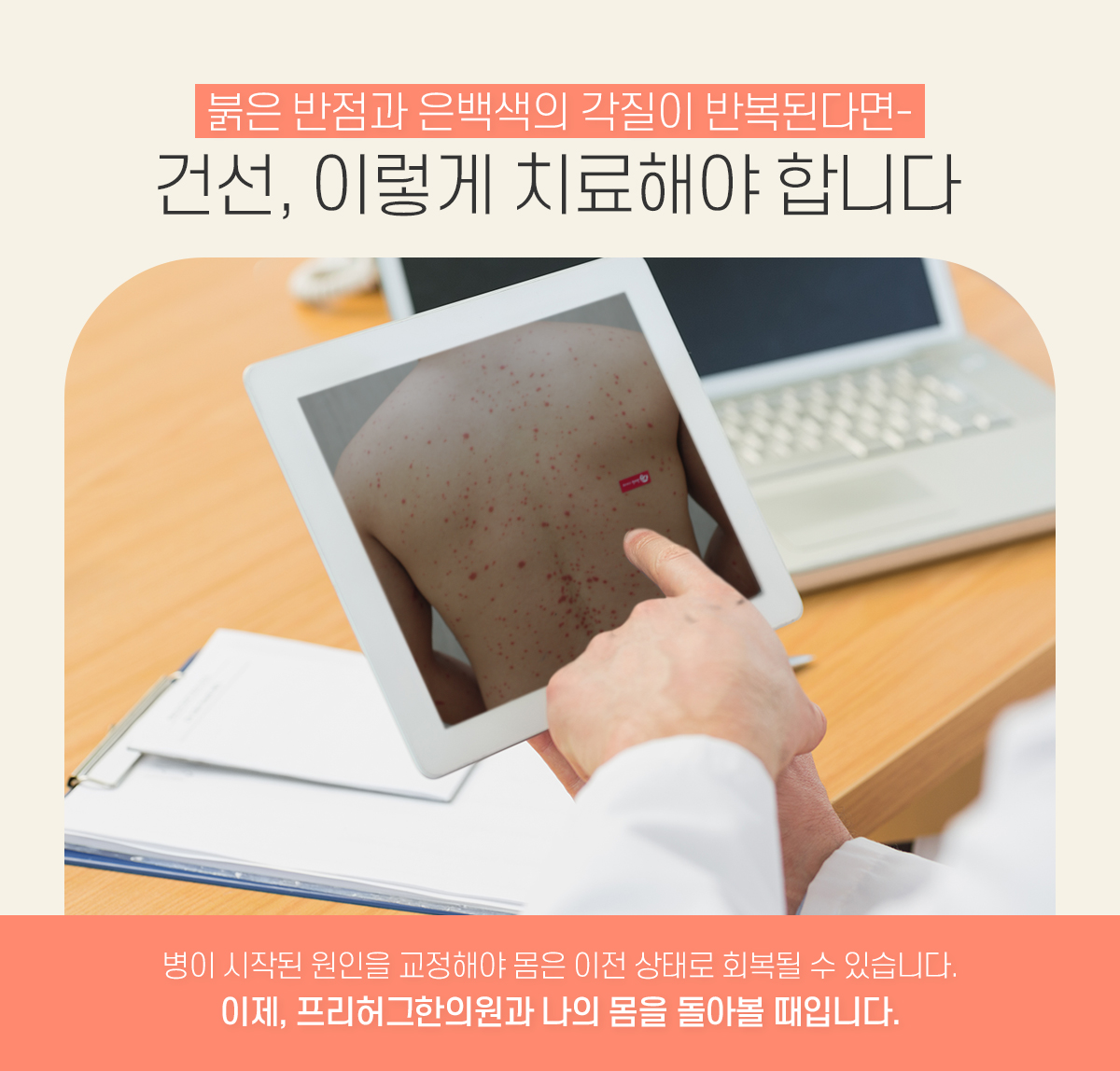 건선, 이렇게 치료해야 합니다