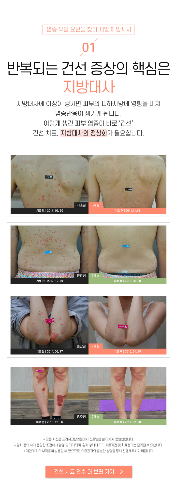1. 반복되는 건선 증상의 핵심은 지방대사