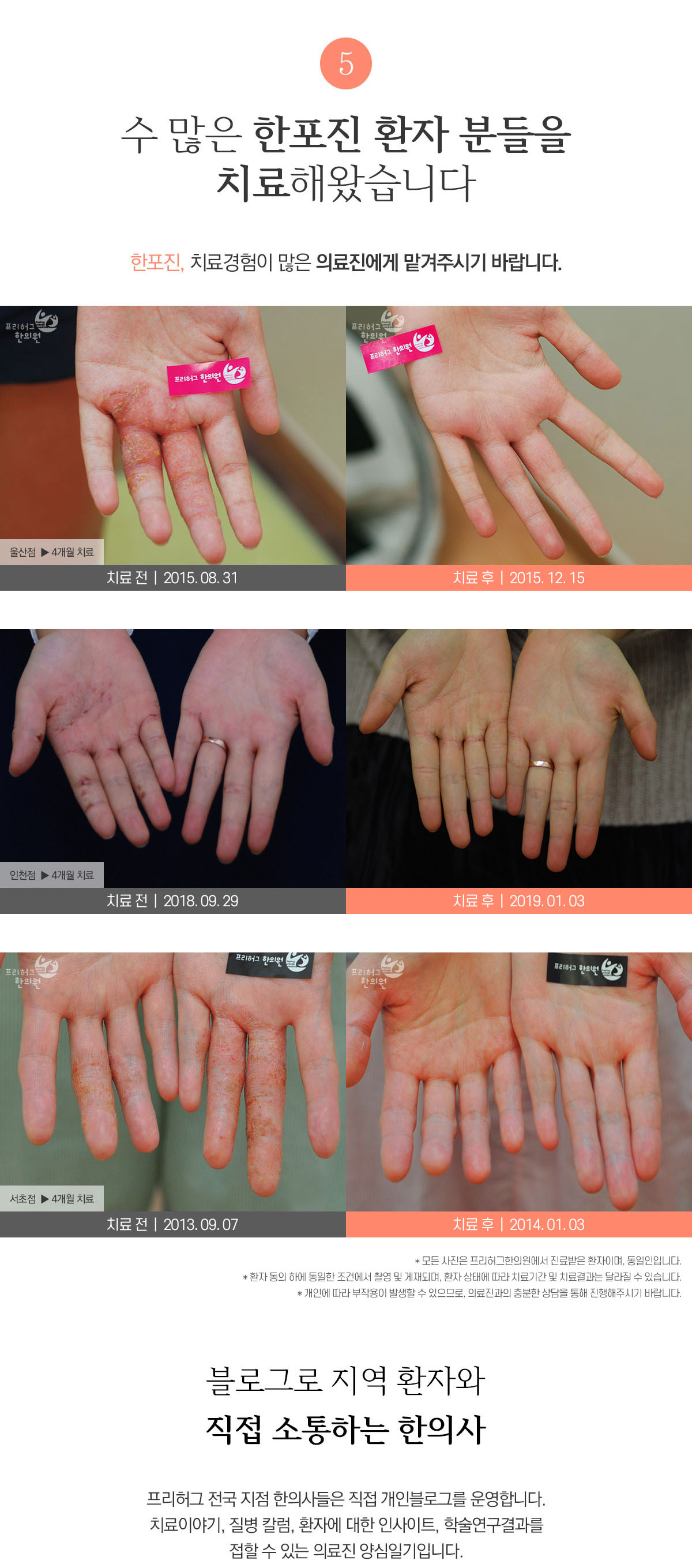 수 많은 한포진 환자 분들을 치료해왔습니다