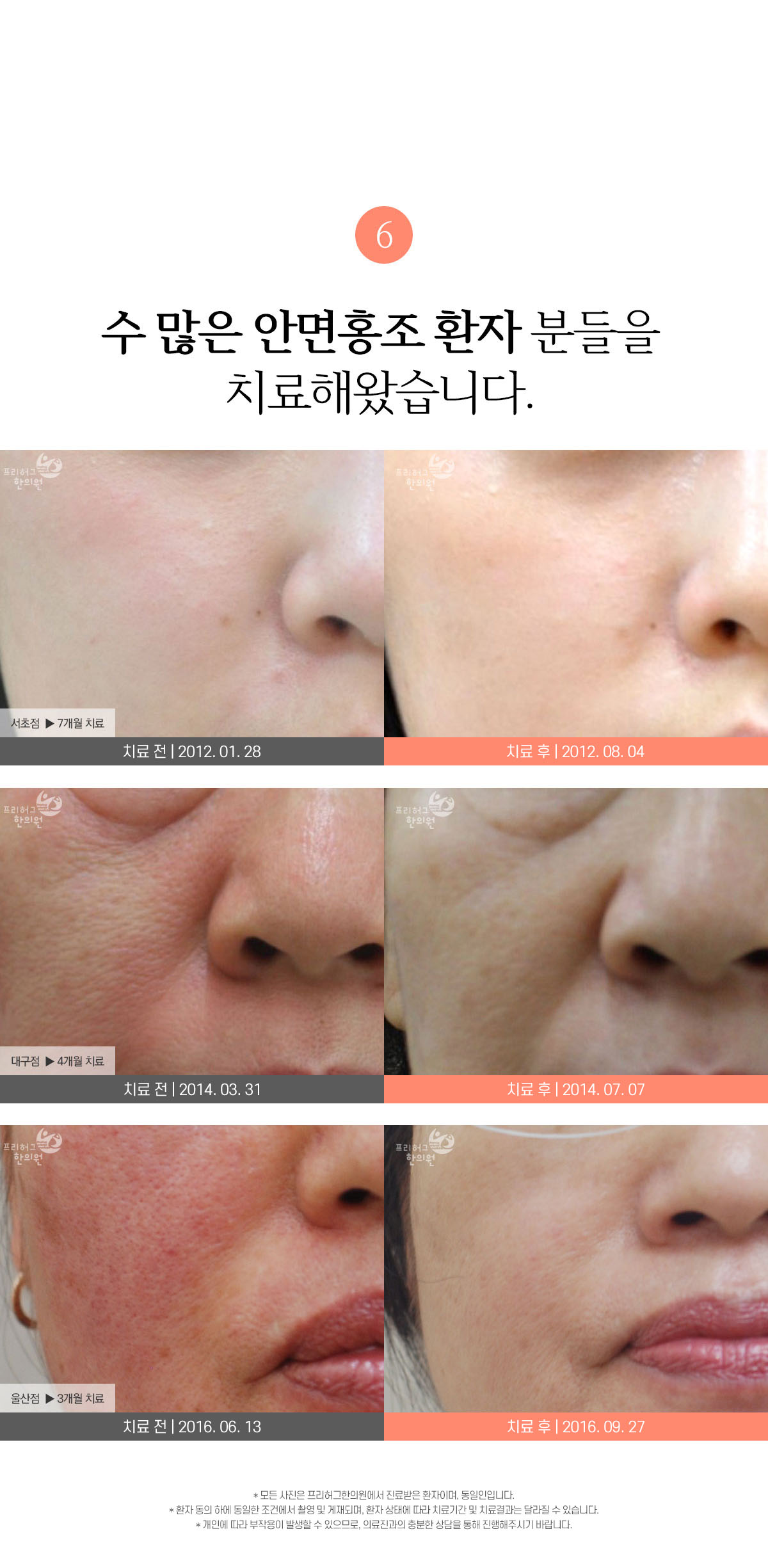 수 많은 안면홍조 환자 분들을 치료해왔습니다